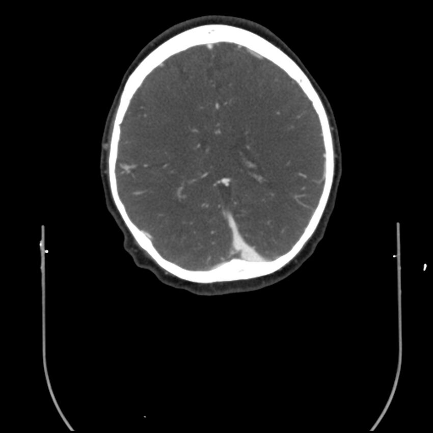 Acute M1 occlusion with ischemic penumbra (CT perfusion) (Radiopaedia 71897-82344 Axial C+ arterial phase thins 27).jpg