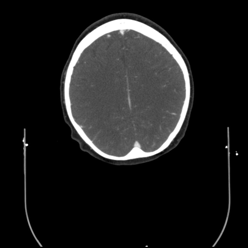 Acute M1 occlusion with ischemic penumbra (CT perfusion) (Radiopaedia 71897-82344 Axial C+ arterial phase thins 3).jpg