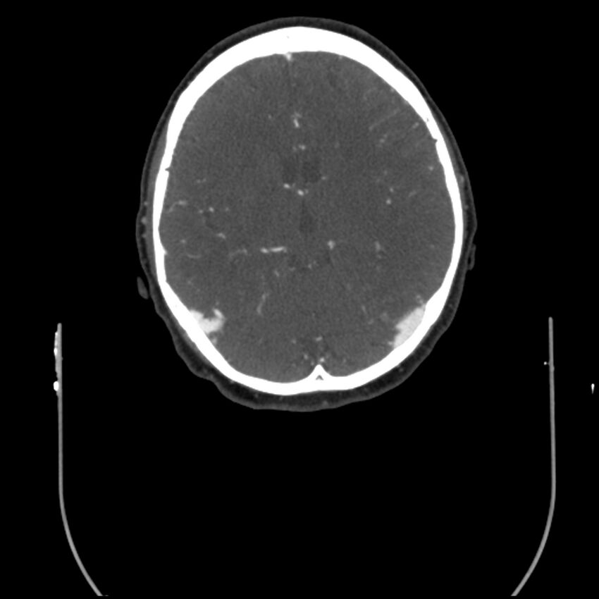 Acute M1 occlusion with ischemic penumbra (CT perfusion) (Radiopaedia 71897-82344 Axial C+ arterial phase thins 51).jpg