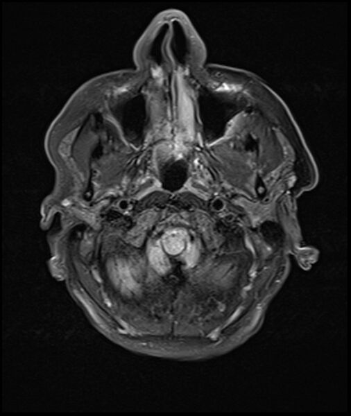 File:Acute P1 occlusion with PCA ischemia penumbra (CT perfusion) (Radiopaedia 72084-82590 Axial FLAIR 2).jpg
