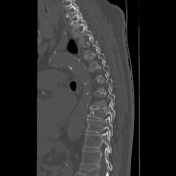 File:Acute and chronic vertebral compression fractures (Radiopaedia 31608-32494 Sagittal bone window 21).jpg