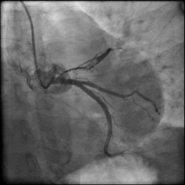 File:Acute anteroseptal myocardial infarction (Radiopaedia 68409-77946 LAO caudal (spider view) LAD and CX 23).jpg