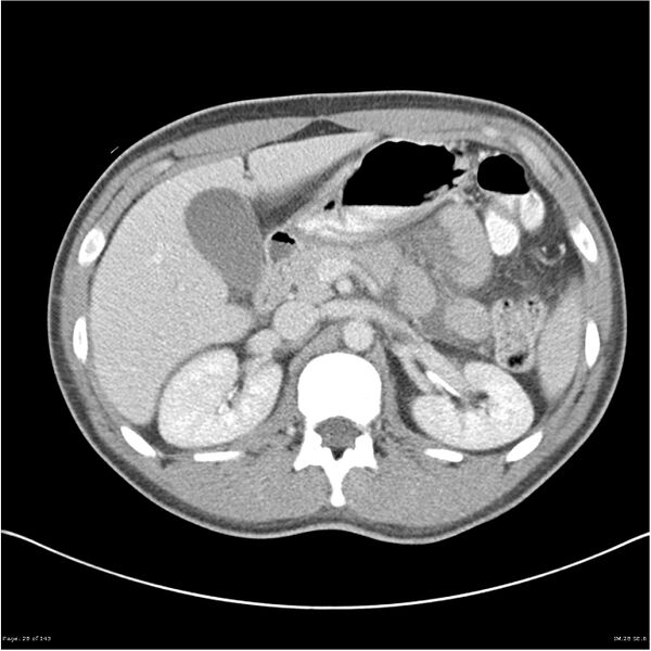 File:Acute appendicitis (Radiopaedia 25364-25615 B 18).jpg