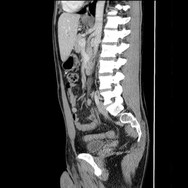 File:Acute appendicitis (Radiopaedia 27049-27227 Sagittal C+ portal venous phase 46).jpg