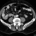 Acute appendicitis arising from a malrotated cecum (Radiopaedia 19970-19997 Axial C+ portal venous phase 23).jpg