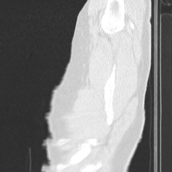 File:Acute aspiration pneumonitis (Radiopaedia 33605-34703 Sagittal lung window 5).jpg