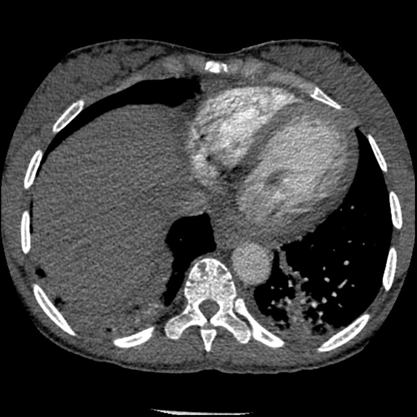 Acute chest syndrome - sickle cell disease (Radiopaedia 42375-45499 Axial C+ CTPA 146).jpg
