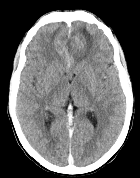 File:Acute disseminated encephalomyelitis (ADEM) (Radiopaedia 65319-74348 Axial C+ delayed 16).png