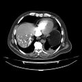 Acute heart failure (CT) (Radiopaedia 79835-93075 Axial C+ arterial phase 49).jpg