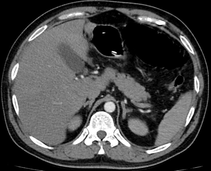 File:Acute mesenteric ischemia - superior mesenteric artery thrombosis (Radiopaedia 73947-84776 Axial C+ arterial phase 5).jpg