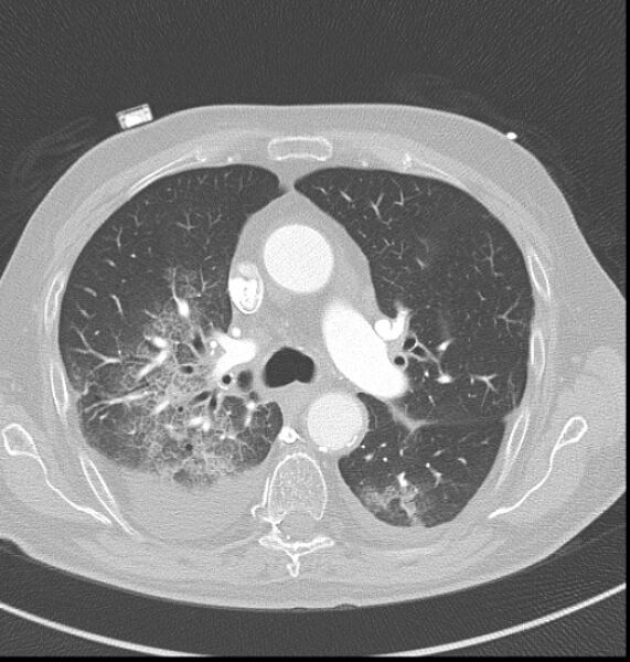 File:Acute myocardial infarction (Radiopaedia 23413-23481 lung window 15).jpg