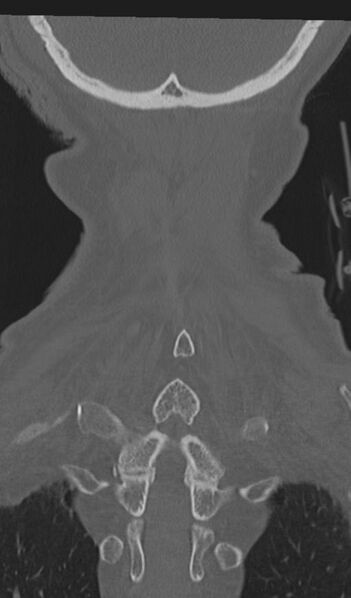 File:Acute on chronic subdural hematoma and thoracic vertebral injury in a multitrauma patient (Radiopaedia 31698-32619 Coronal bone window 59).jpg