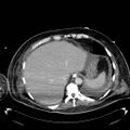 Acute pancreatic necrosis (Radiopaedia 13560-18503 Axial C+ portal venous phase 9).jpg
