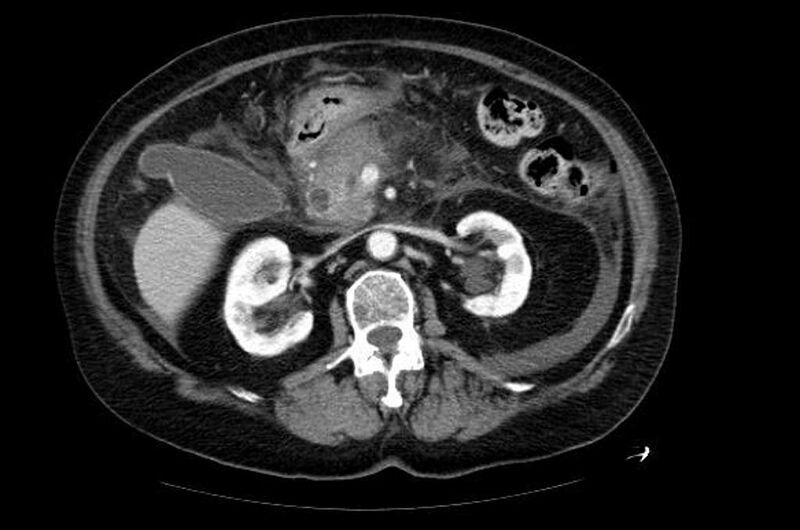 File:Acute pancreatitis (Radiopaedia 11163-11528 Axial 3).jpg