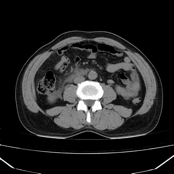 File:Acute pancreatitis (Radiopaedia 22572-22596 Axial non-contrast 35).jpg