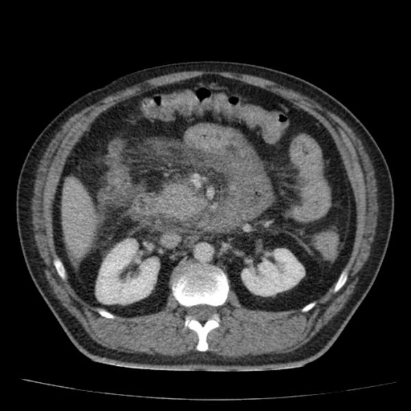 File:Acute pancreatitis (Radiopaedia 26663-26813 Axial C+ portal venous phase 36).jpg