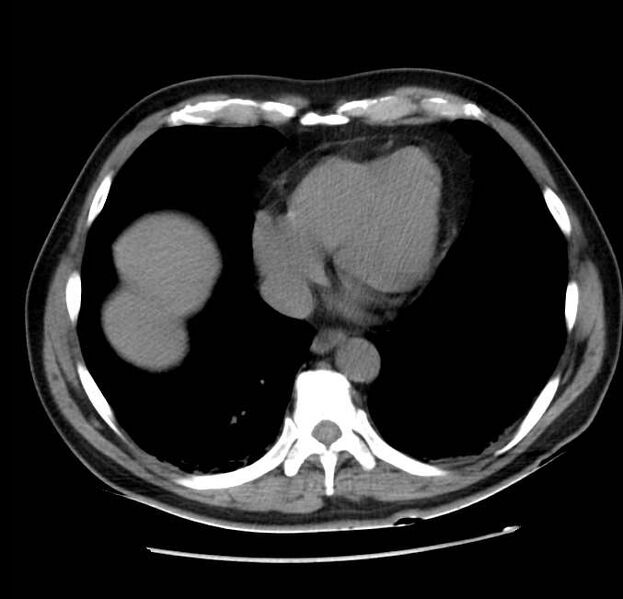 File:Acute pancreatitis - Balthazar E (Radiopaedia 23080-23110 Axial non-contrast 4).jpg