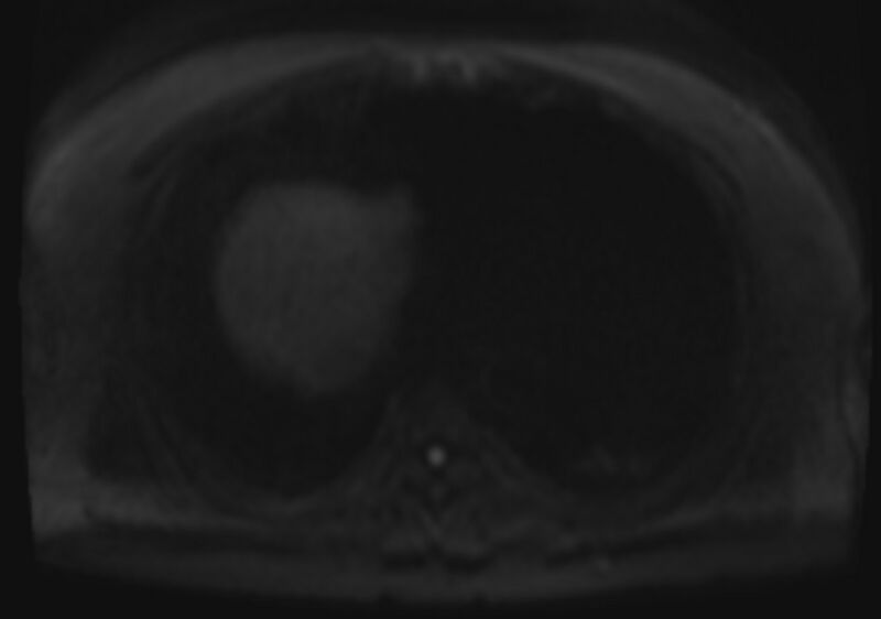 File:Acute portal vein thrombosis (Radiopaedia 73198-83925 Axial DWI 66).jpg