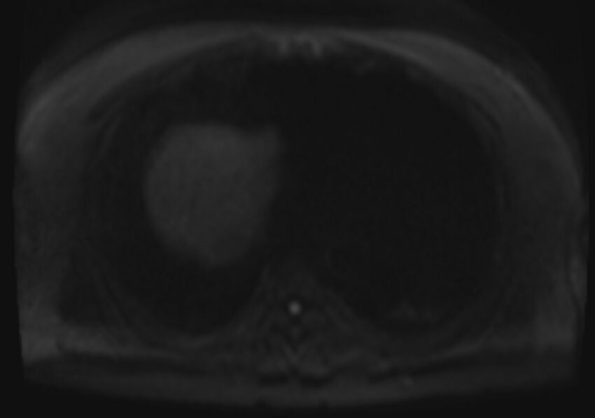 Acute portal vein thrombosis (Radiopaedia 73198-83925 Axial DWI 66).jpg