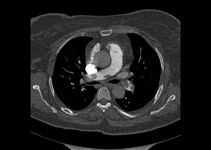 Acute pulmonary embolism (Radiopaedia 29938-30466 Axial C+ CTPA 55).jpg
