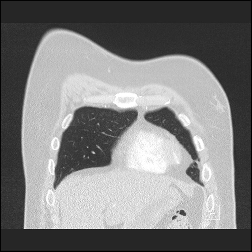Acute pulmonary embolism with pulmonary infarct (Radiopaedia 73062-83768 Coronal lung window 11).jpg