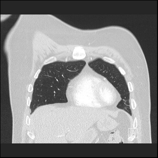 File:Acute pulmonary embolism with pulmonary infarct (Radiopaedia 73062-83768 Coronal lung window 15).jpg