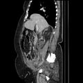 Acute pyelonephritis (Radiopaedia 25657-25837 Sagittal renal parenchymal phase 33).jpg