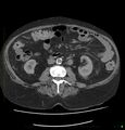Acute renal failure post IV contrast injection- CT findings (Radiopaedia 47815-52557 Axial non-contrast 41).jpg