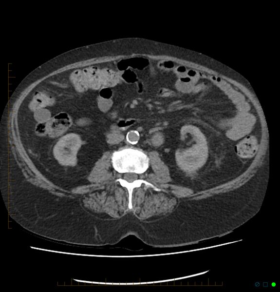 File:Acute renal failure post IV contrast injection- CT findings (Radiopaedia 47815-52557 Axial non-contrast 41).jpg
