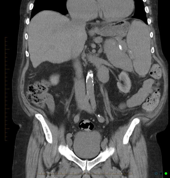 File:Acute renal failure post IV contrast injection- CT findings (Radiopaedia 47815-52557 Coronal non-contrast 22).jpg