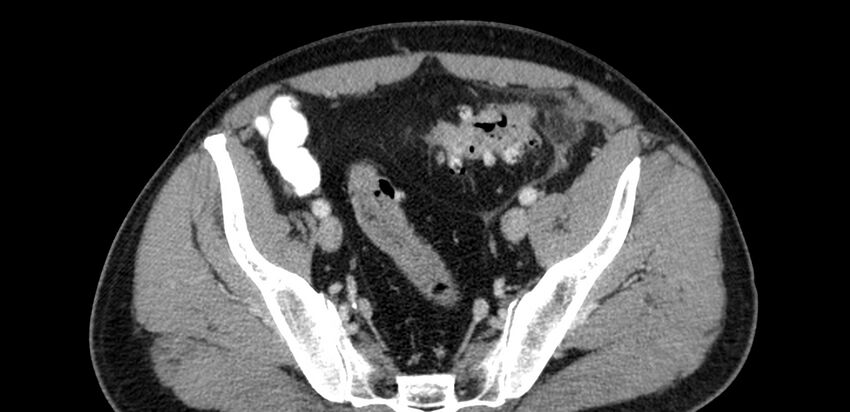 Acute sigmoid colon diverticulitis (Radiopaedia 55507-61976 Axial C+ portal venous phase 88).jpg