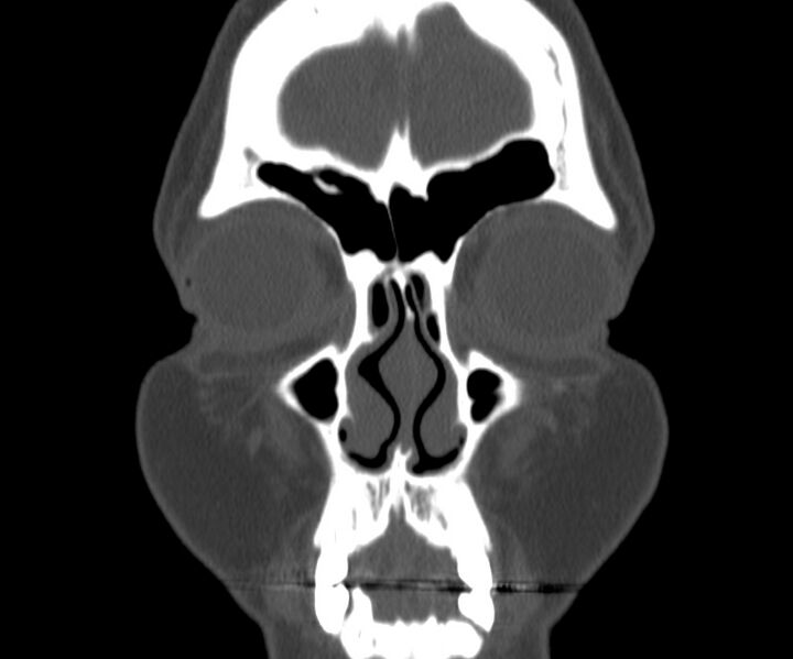 File:Acute sinusitis (Radiopaedia 22419-22455 Coronal bone window 7).jpg