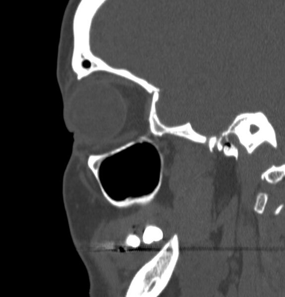 File:Acute sinusitis (Radiopaedia 22419-22455 Sagittal non-contrast 5).jpg