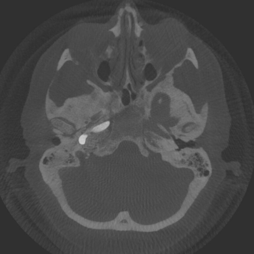 Acute subarachnoid hemorrhage and accessory anterior cerebral artery (Radiopaedia 69231-79010 Axial arterial - MIP 13).jpg