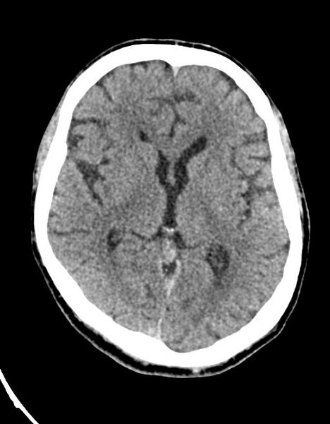 File:Acute superior cerebellar artery territory infarct (Radiopaedia 84104-99359 Axial non-contrast 36).jpg