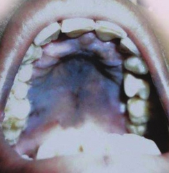 Hyperpigmentation in the palate
