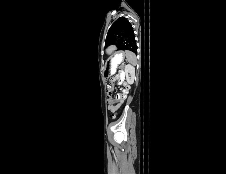 File:Addison disease (Radiopaedia 49318-54412 Sagittal C+ portal venous phase 16).jpg