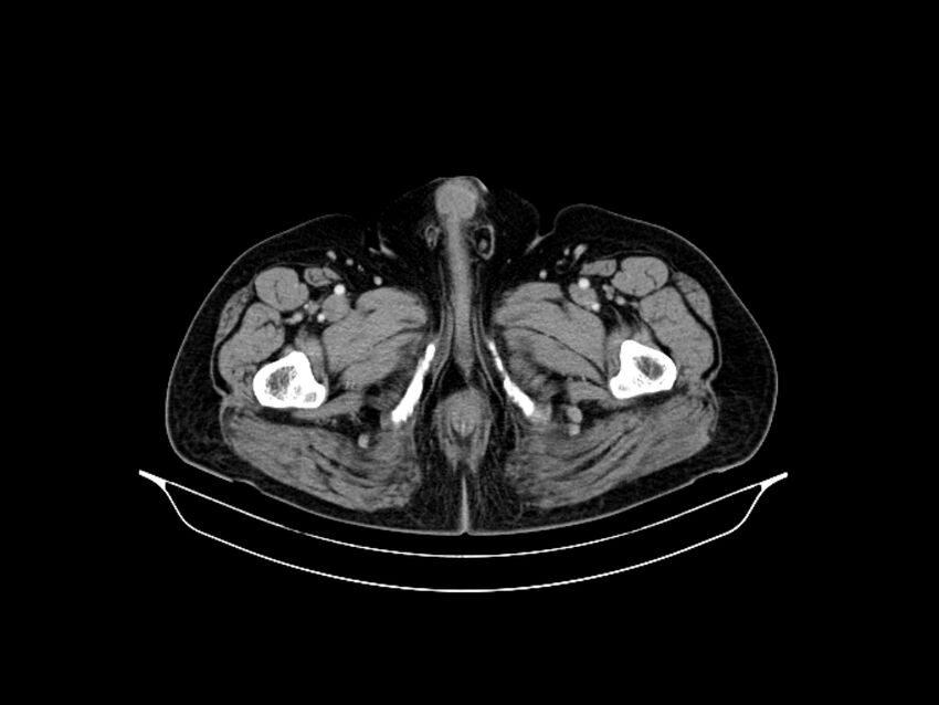 Adenocarcinoma of pancreas with hepatic metastasis (Radiopaedia 64332-73122 Axial C+ portal venous phase 108).jpg