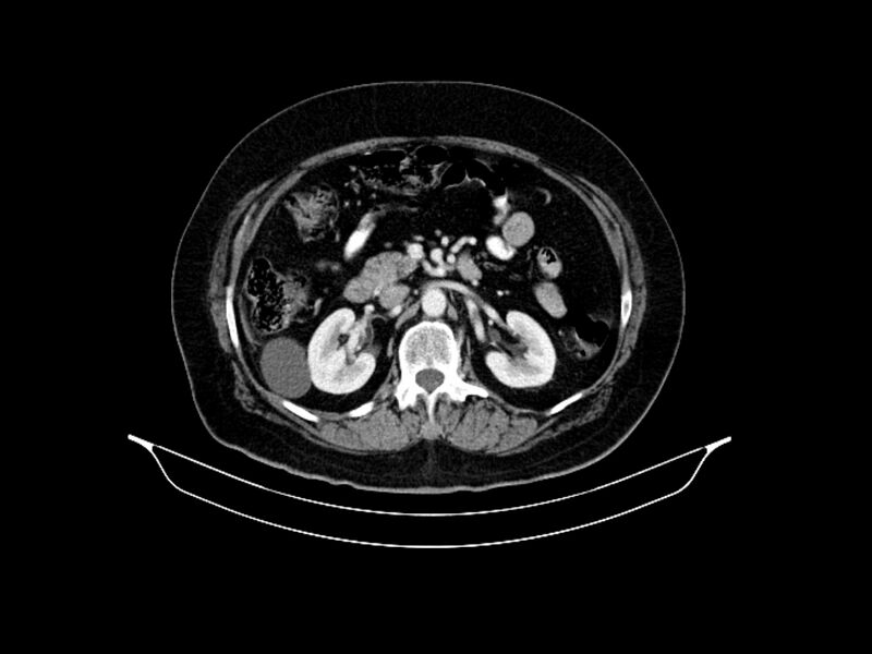 File:Adenocarcinoma of pancreas with hepatic metastasis (Radiopaedia 64332-73122 Axial C+ portal venous phase 42).jpg