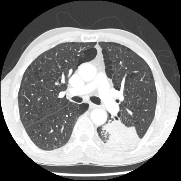 File:Adenocarcinoma of the lung - micropapillary predominant (Radiopaedia 42446-45563 C 28).jpg