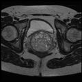Adenoma malignum of the cervix (Radiopaedia 24460-24765 C 19).jpg