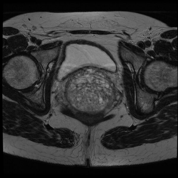 File:Adenoma malignum of the cervix (Radiopaedia 24460-24765 C 19).jpg