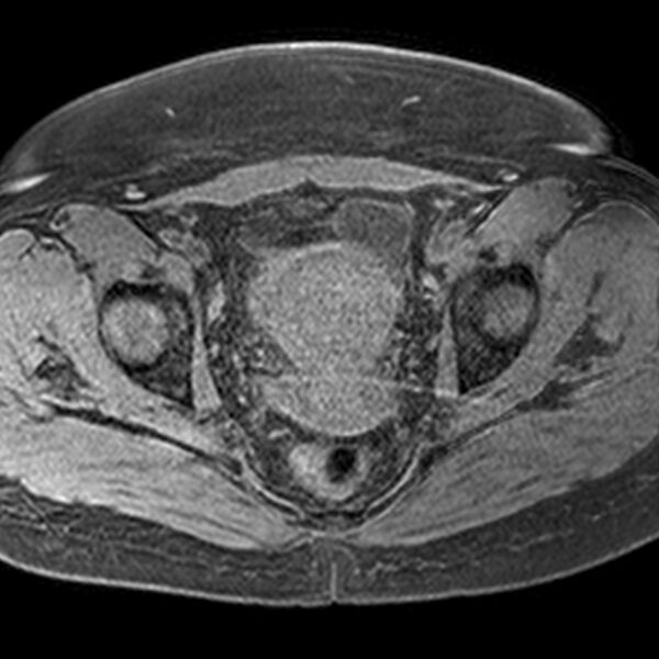 File:Adenomyoma of the uterus (Radiopaedia 9871-10439 Axial T1 fat sat 9).jpg
