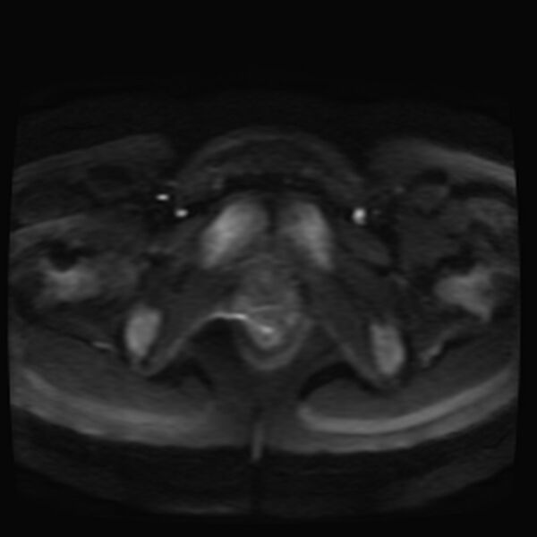 File:Adenomyosis on MRI (Radiopaedia 29328-29780 Axial DWI 13).jpg