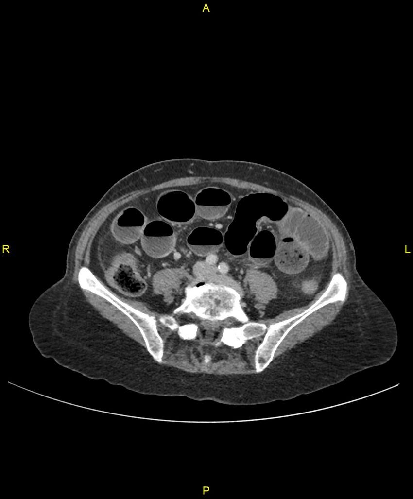 Adhesional small bowel obstruction (Radiopaedia 85402-101024 Axial C+ portal venous phase 183).jpg