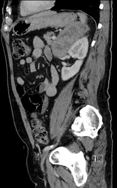 File:Adrenal lymphoma (Radiopaedia 73730-84529 Sagittal C+ portal venous phase 76).jpg