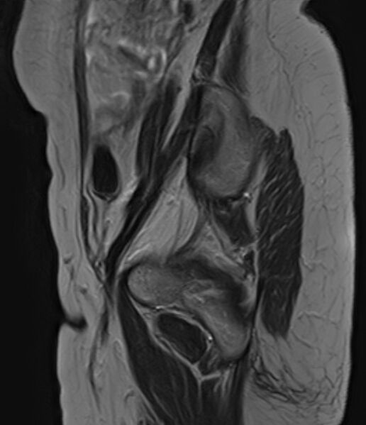 File:Adult granulosa cell tumor of the ovary (Radiopaedia 71581-81950 Sagittal T2 3).jpg