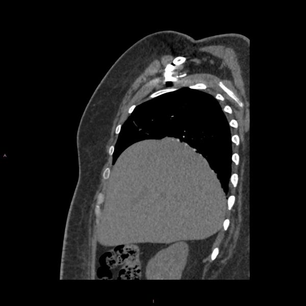 File:Agenesis of the left hepatic lobe (Radiopaedia 77284-89359 Sagittal C+ CTPA 23).jpg