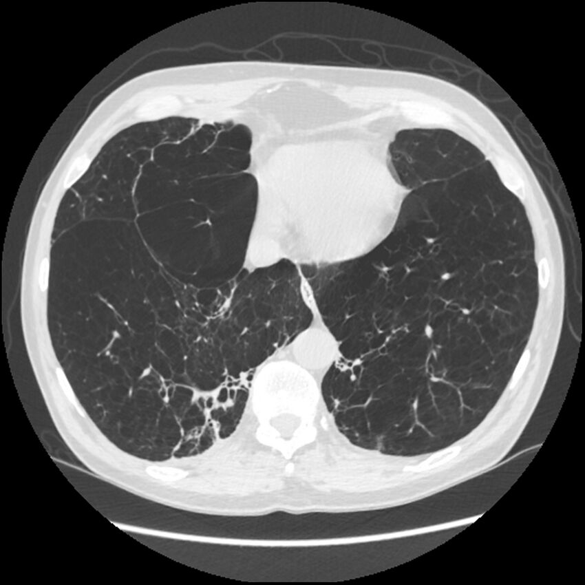 Alpha-1-antitrypsin deficiency (Radiopaedia 40993-43722 Axial lung window 186).jpg