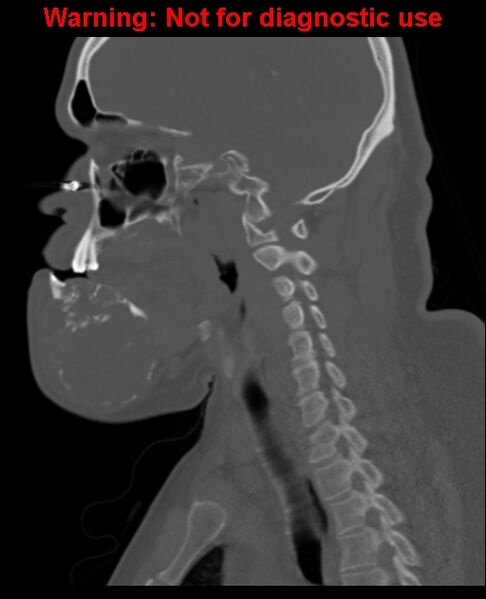 File:Ameloblastoma (Radiopaedia 33126-34164 Sagittal bone window 45).jpg